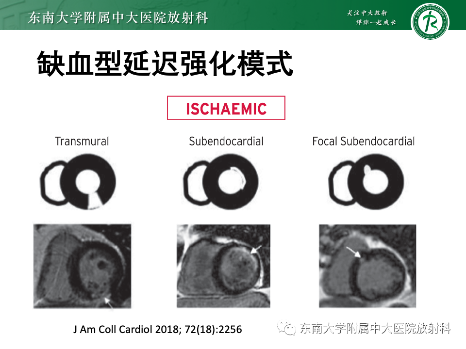 影像PPT - 【PPT】CMR在心肌梗死中的运用-29 影像PPT - 【PPT】CMR在心肌梗死中的运用-29
