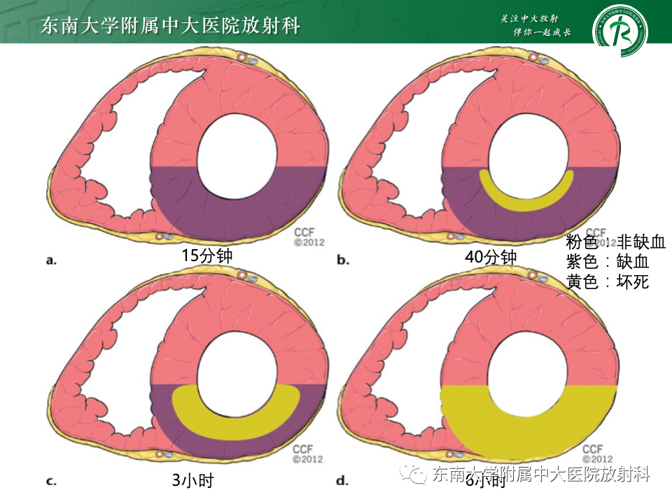 影像PPT - 【PPT】CMR在心肌梗死中的运用-31 影像PPT - 【PPT】CMR在心肌梗死中的运用-31