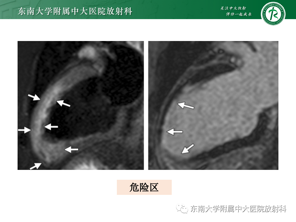 影像PPT - 【PPT】CMR在心肌梗死中的运用-33 影像PPT - 【PPT】CMR在心肌梗死中的运用-33