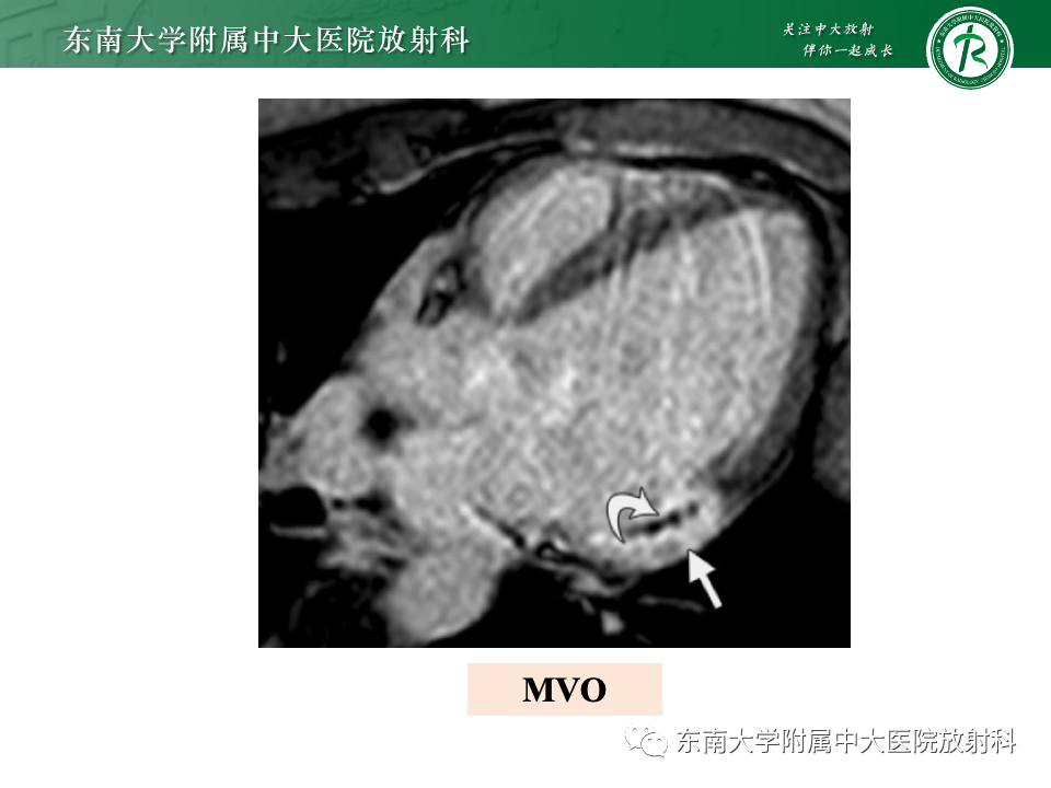 影像PPT - 【PPT】CMR在心肌梗死中的运用-35 影像PPT - 【PPT】CMR在心肌梗死中的运用-35