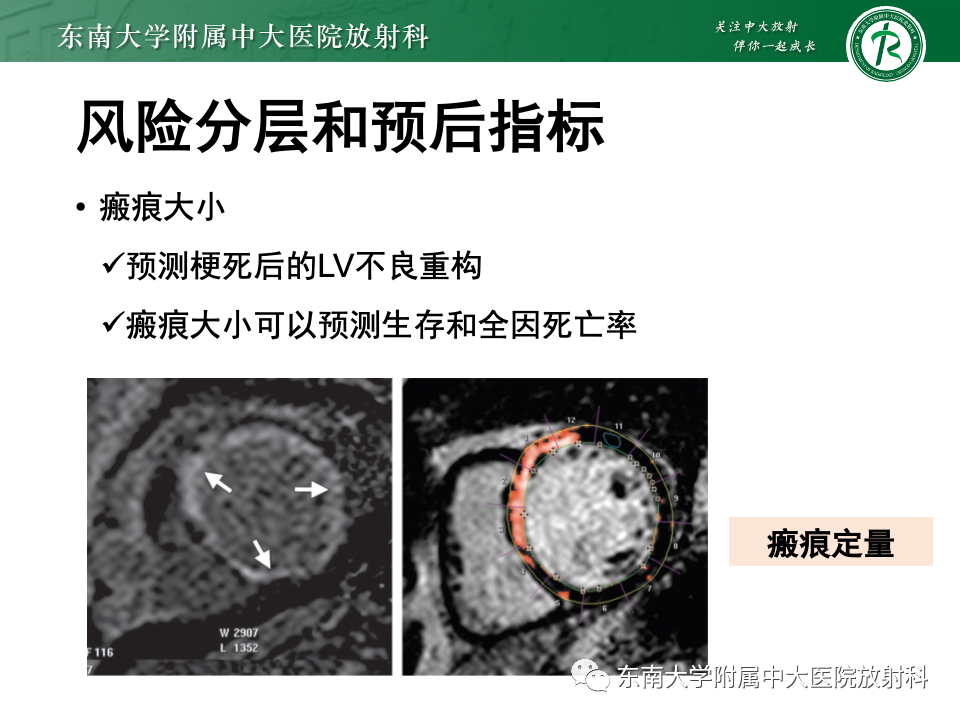 影像PPT - 【PPT】CMR在心肌梗死中的运用-38 影像PPT - 【PPT】CMR在心肌梗死中的运用-38