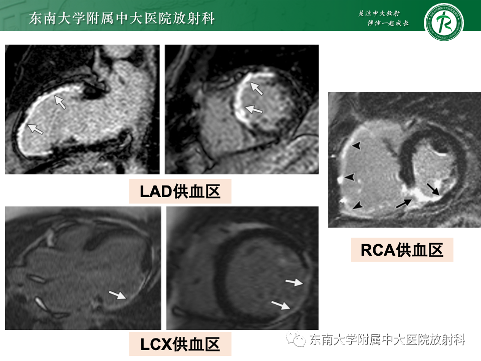 影像PPT - 【PPT】CMR在心肌梗死中的运用-37 影像PPT - 【PPT】CMR在心肌梗死中的运用-37
