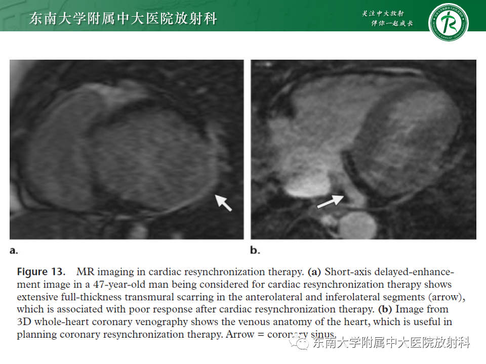 影像PPT - 【PPT】CMR在心肌梗死中的运用-41 影像PPT - 【PPT】CMR在心肌梗死中的运用-41