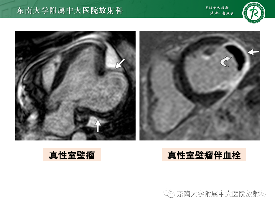 影像PPT - 【PPT】CMR在心肌梗死中的运用-45 影像PPT - 【PPT】CMR在心肌梗死中的运用-45