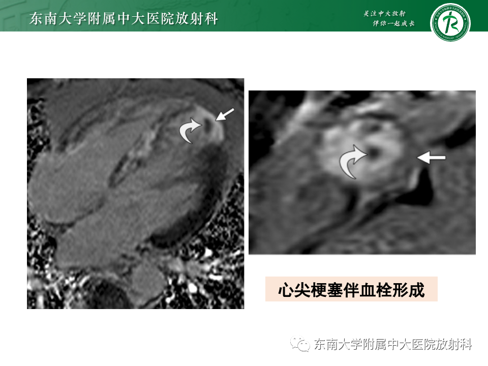 影像PPT - 【PPT】CMR在心肌梗死中的运用-43 影像PPT - 【PPT】CMR在心肌梗死中的运用-43