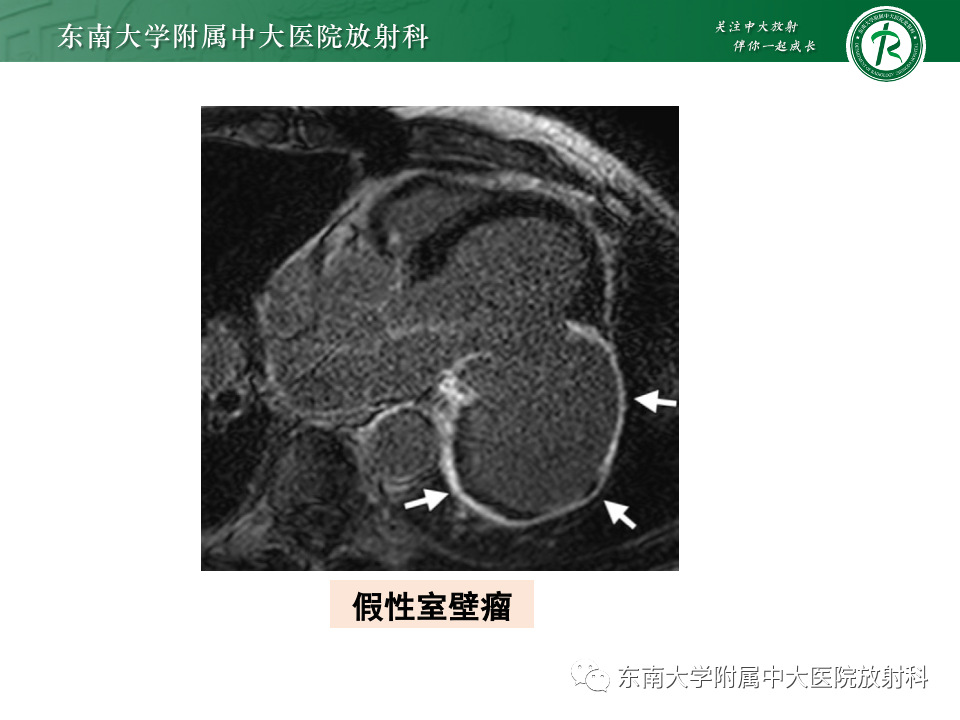 影像PPT - 【PPT】CMR在心肌梗死中的运用-47 影像PPT - 【PPT】CMR在心肌梗死中的运用-47