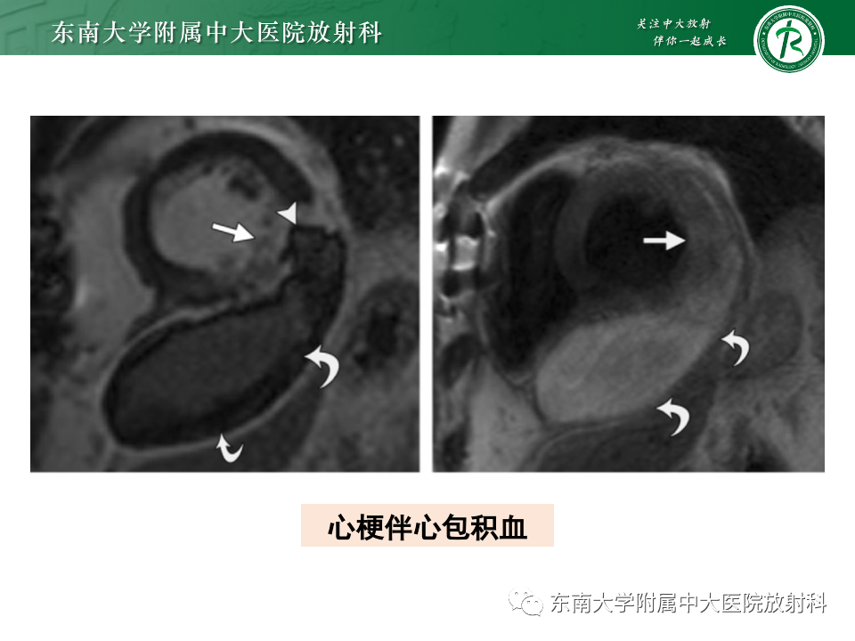 影像PPT - 【PPT】CMR在心肌梗死中的运用-49 影像PPT - 【PPT】CMR在心肌梗死中的运用-49