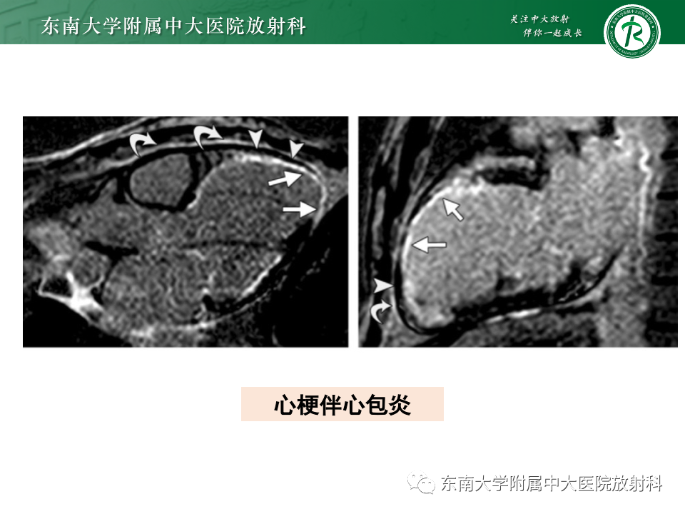 影像PPT - 【PPT】CMR在心肌梗死中的运用-51 影像PPT - 【PPT】CMR在心肌梗死中的运用-51