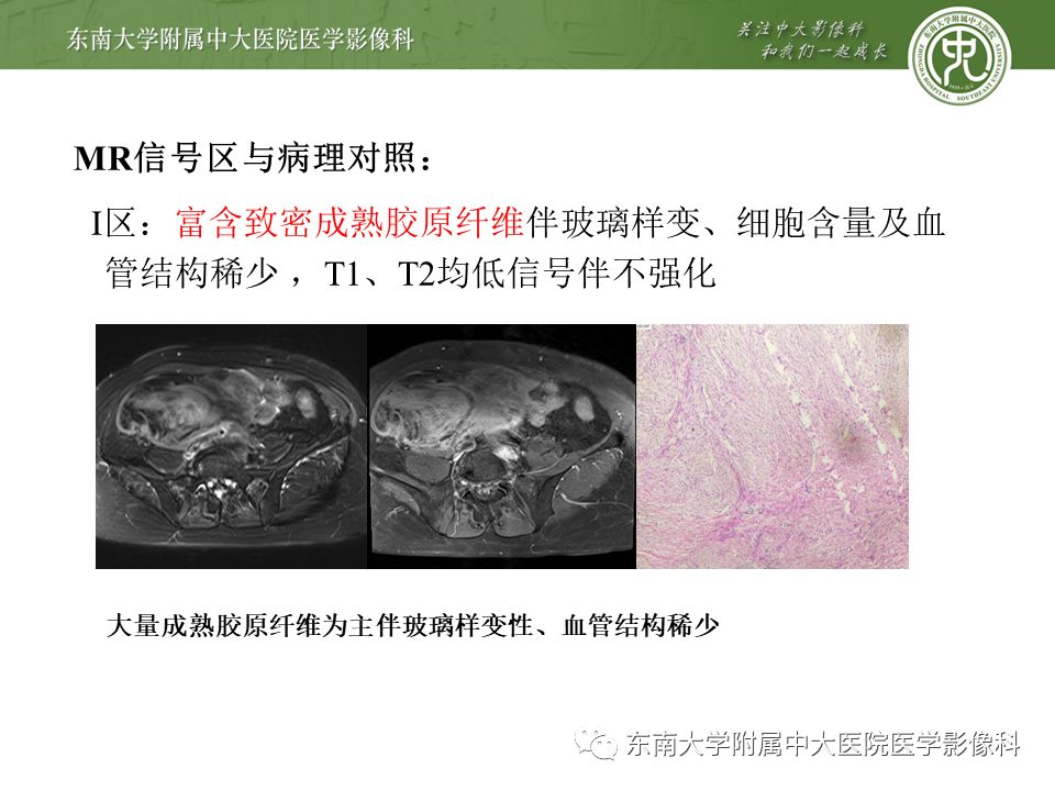 影像PPT - 【病例】肠系膜侵袭性纤维瘤病1例CT-12