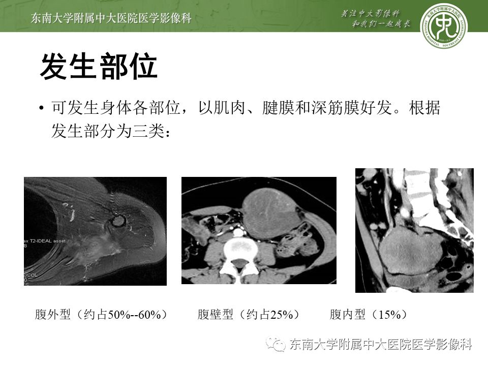 影像PPT - 【病例】肠系膜侵袭性纤维瘤病1例CT-9
