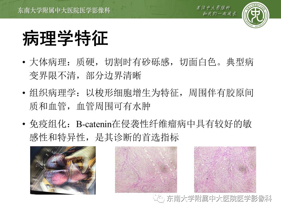 影像PPT - 【病例】肠系膜侵袭性纤维瘤病1例CT-8