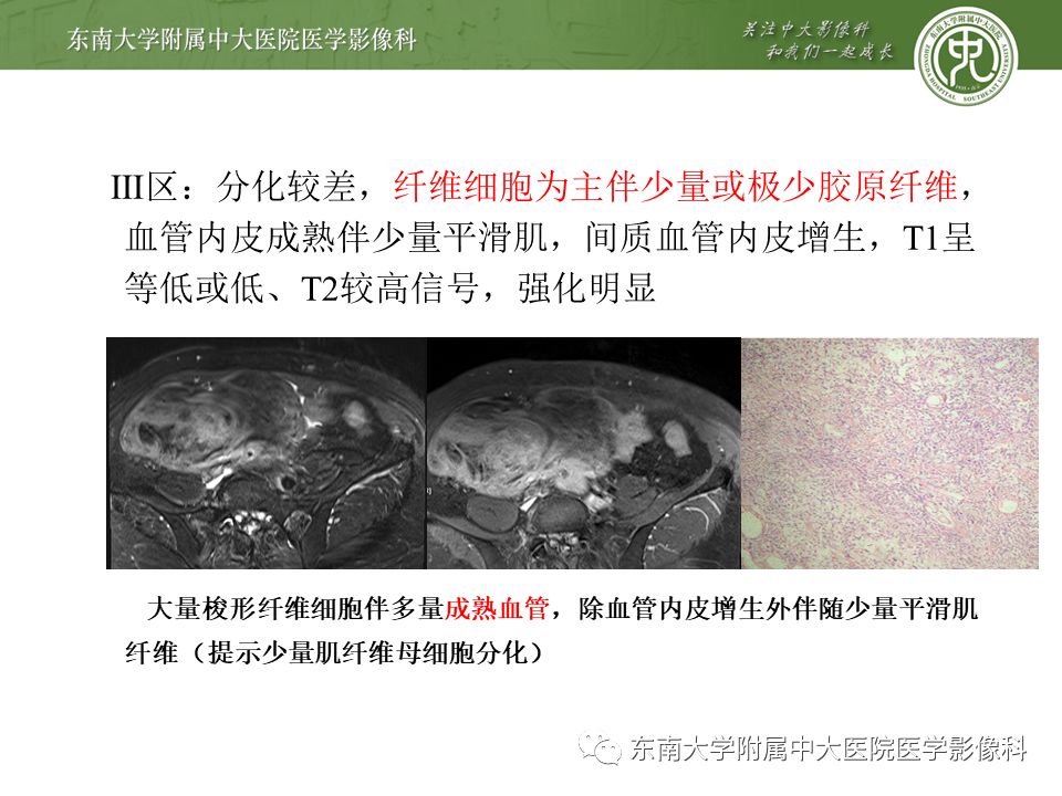 影像PPT - 【病例】肠系膜侵袭性纤维瘤病1例CT-14