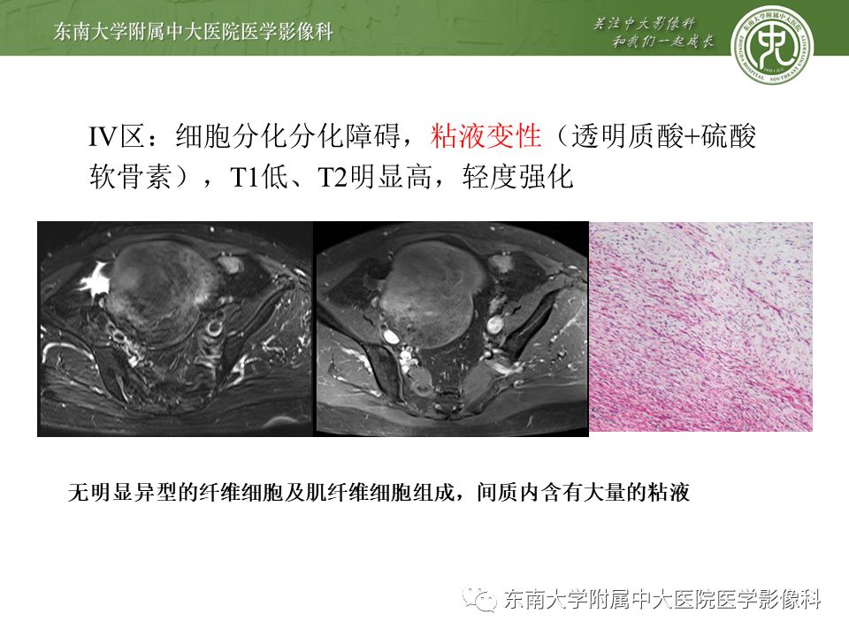 影像PPT - 【病例】肠系膜侵袭性纤维瘤病1例CT-15