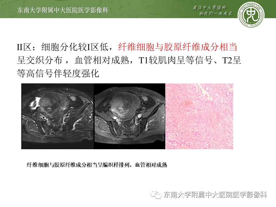 影像PPT - 【病例】肠系膜侵袭性纤维瘤病1例CT-13