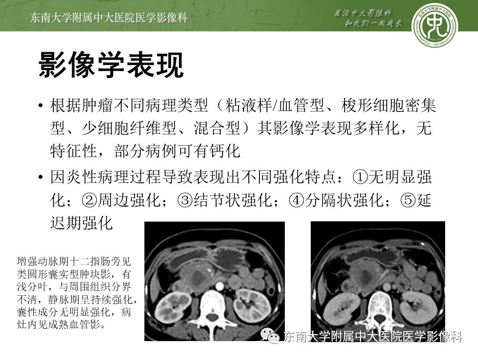 影像PPT - 【病例】肠系膜侵袭性纤维瘤病1例CT-19