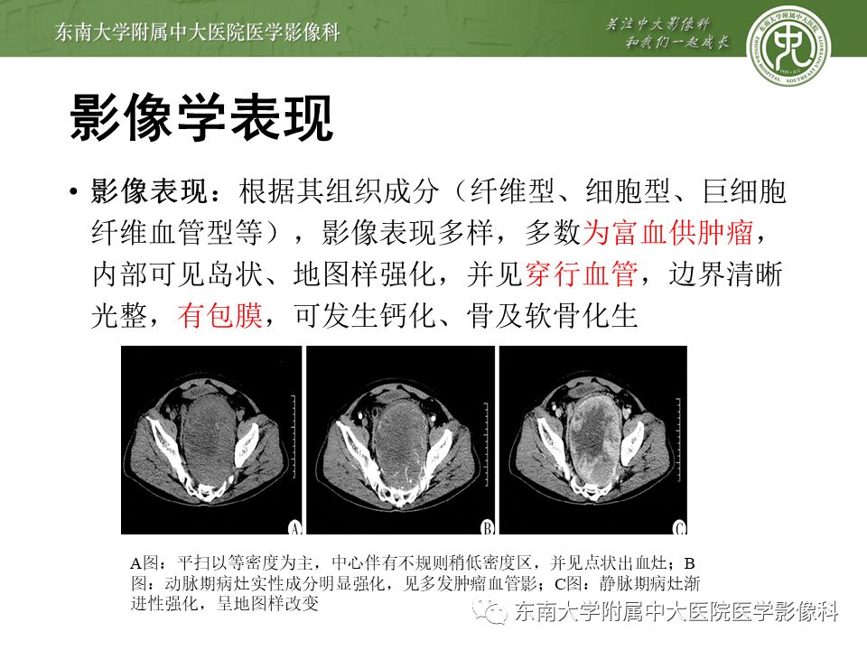 影像PPT - 【病例】肠系膜侵袭性纤维瘤病1例CT-17