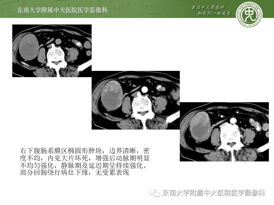 影像PPT - 【病例】肠系膜侵袭性纤维瘤病1例CT-22