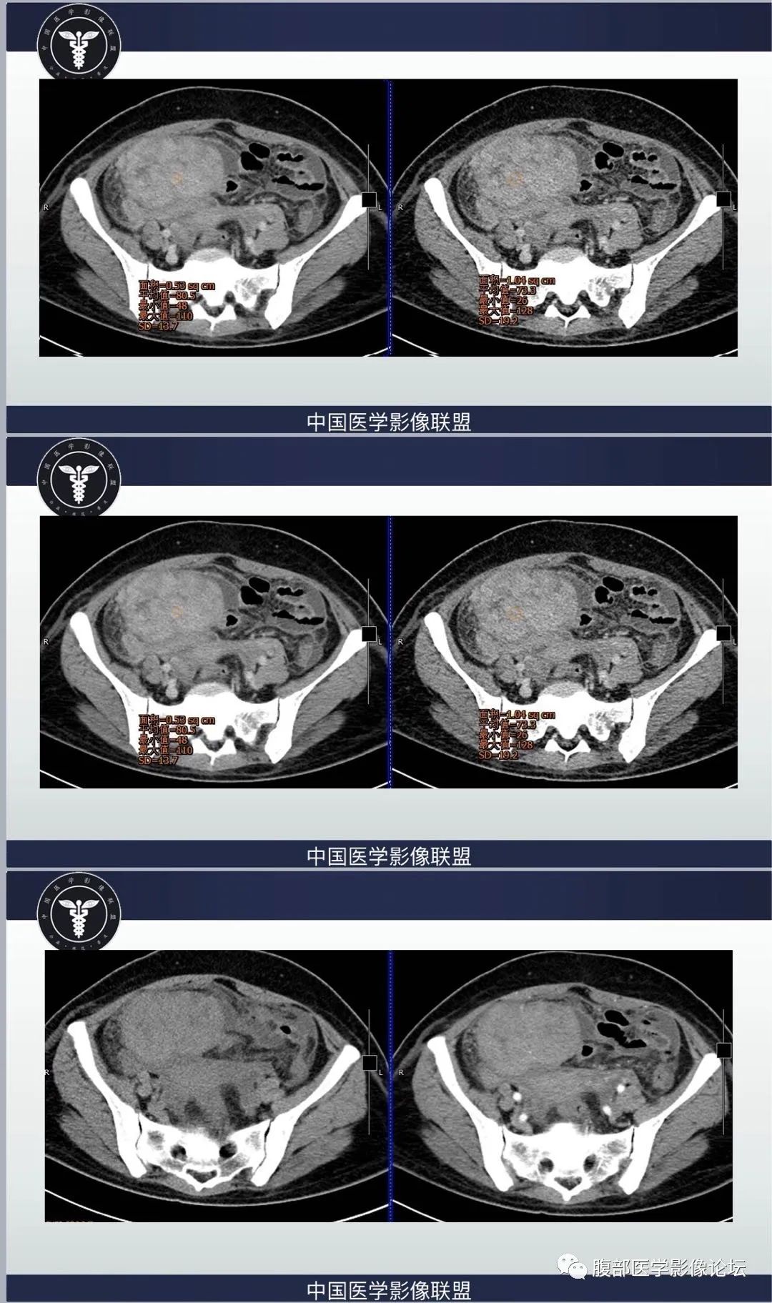 影像PPT - 【病例】肠系膜侵袭性纤维瘤病1例CT-3
