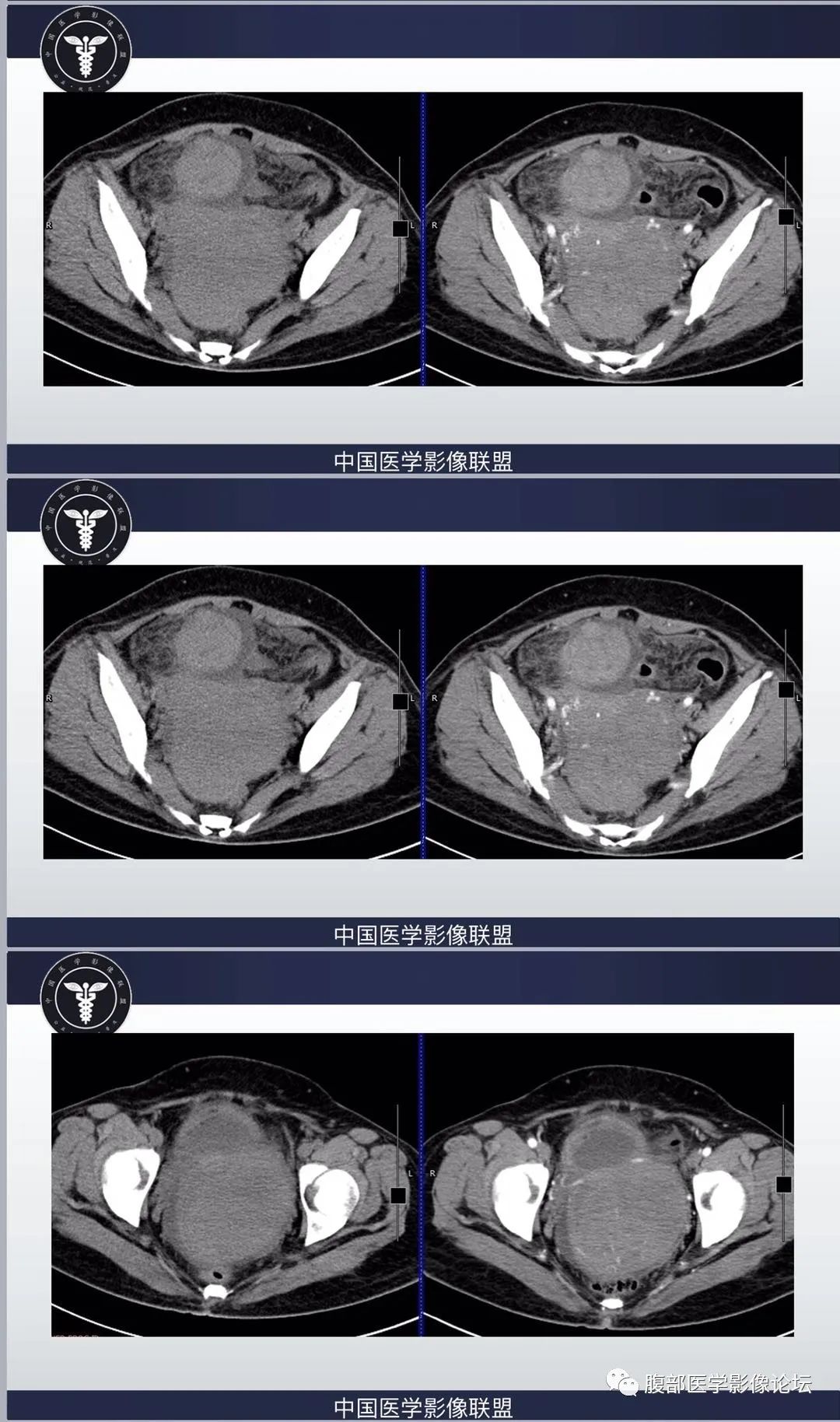 影像PPT - 【病例】肠系膜侵袭性纤维瘤病1例CT-5