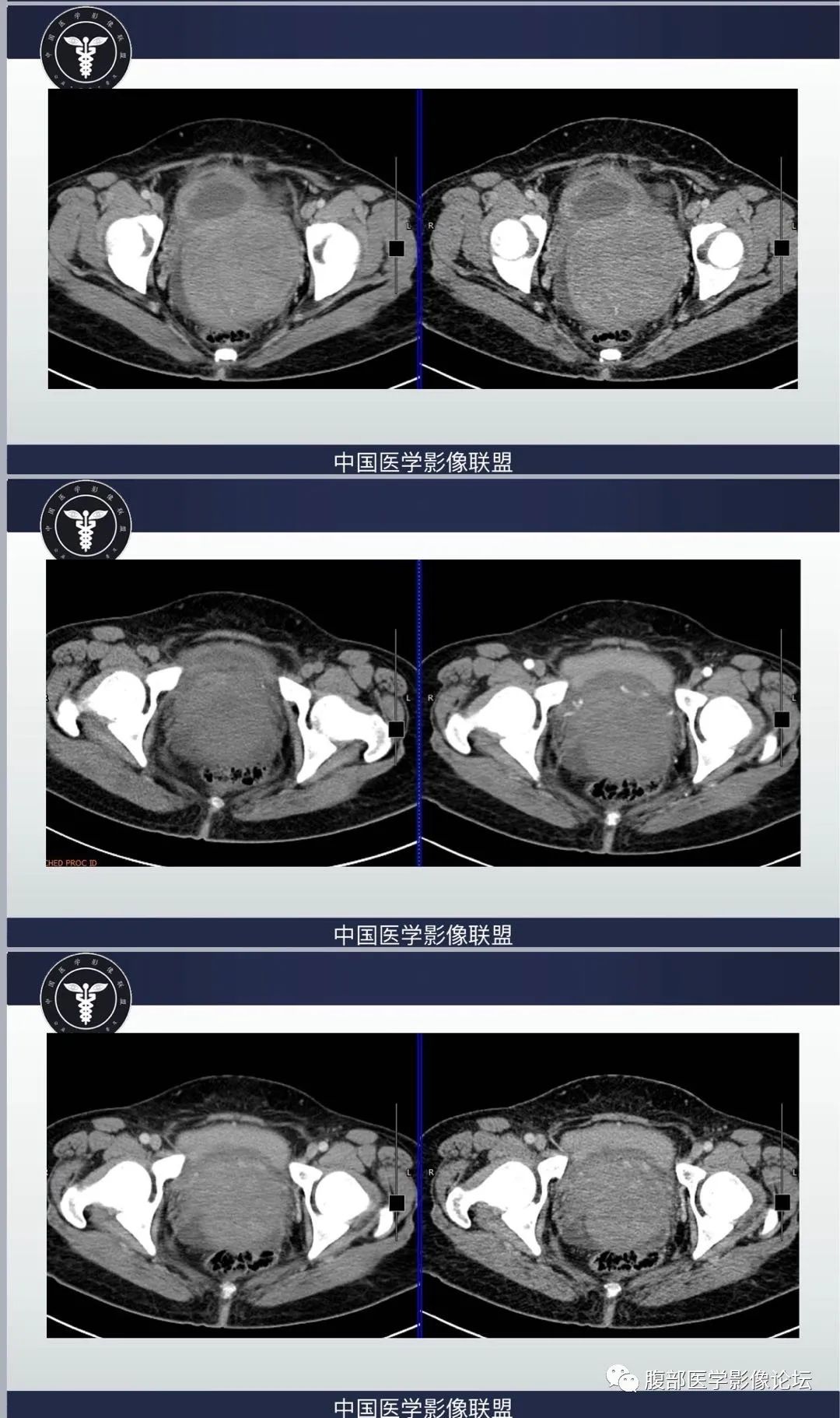 影像PPT - 【病例】肠系膜侵袭性纤维瘤病1例CT-6