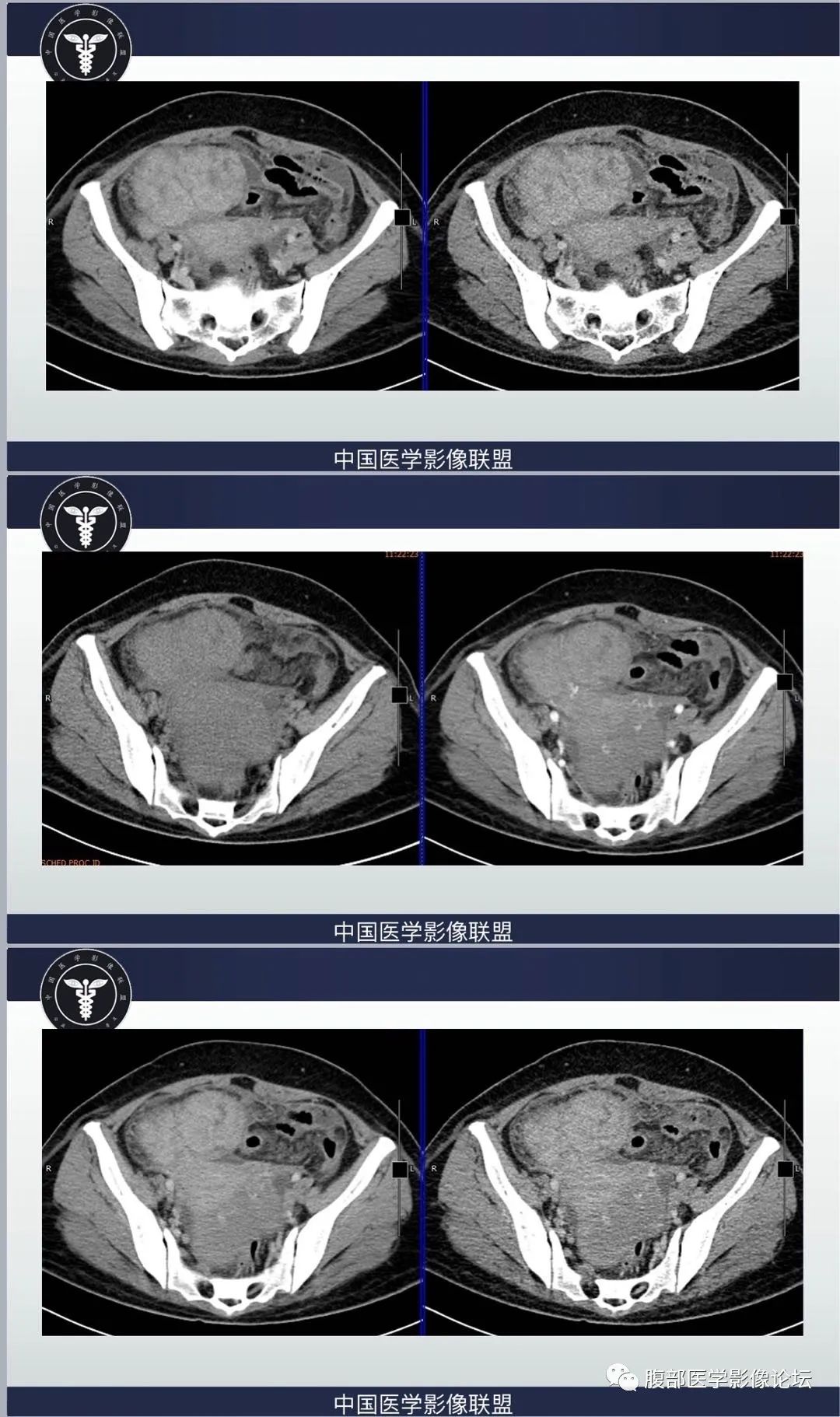 影像PPT - 【病例】肠系膜侵袭性纤维瘤病1例CT-4
