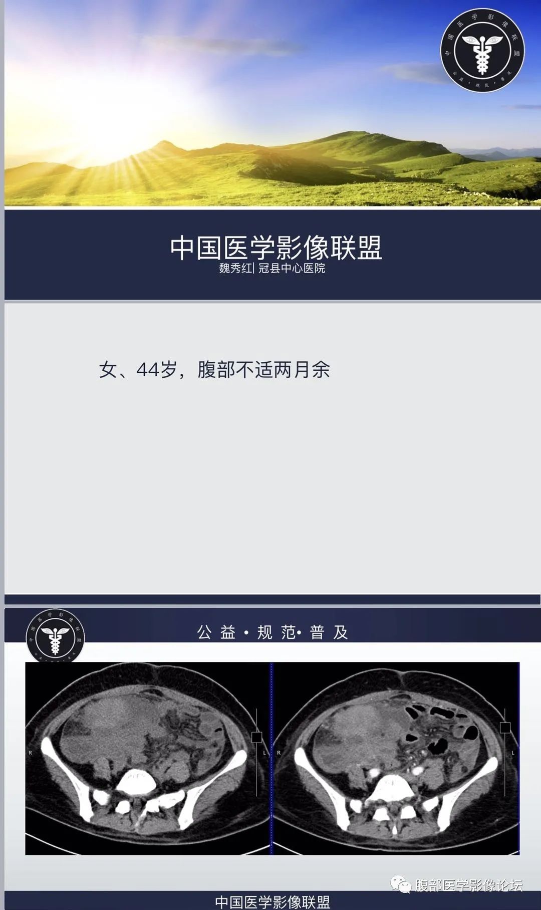 影像PPT - 【病例】肠系膜侵袭性纤维瘤病1例CT-1