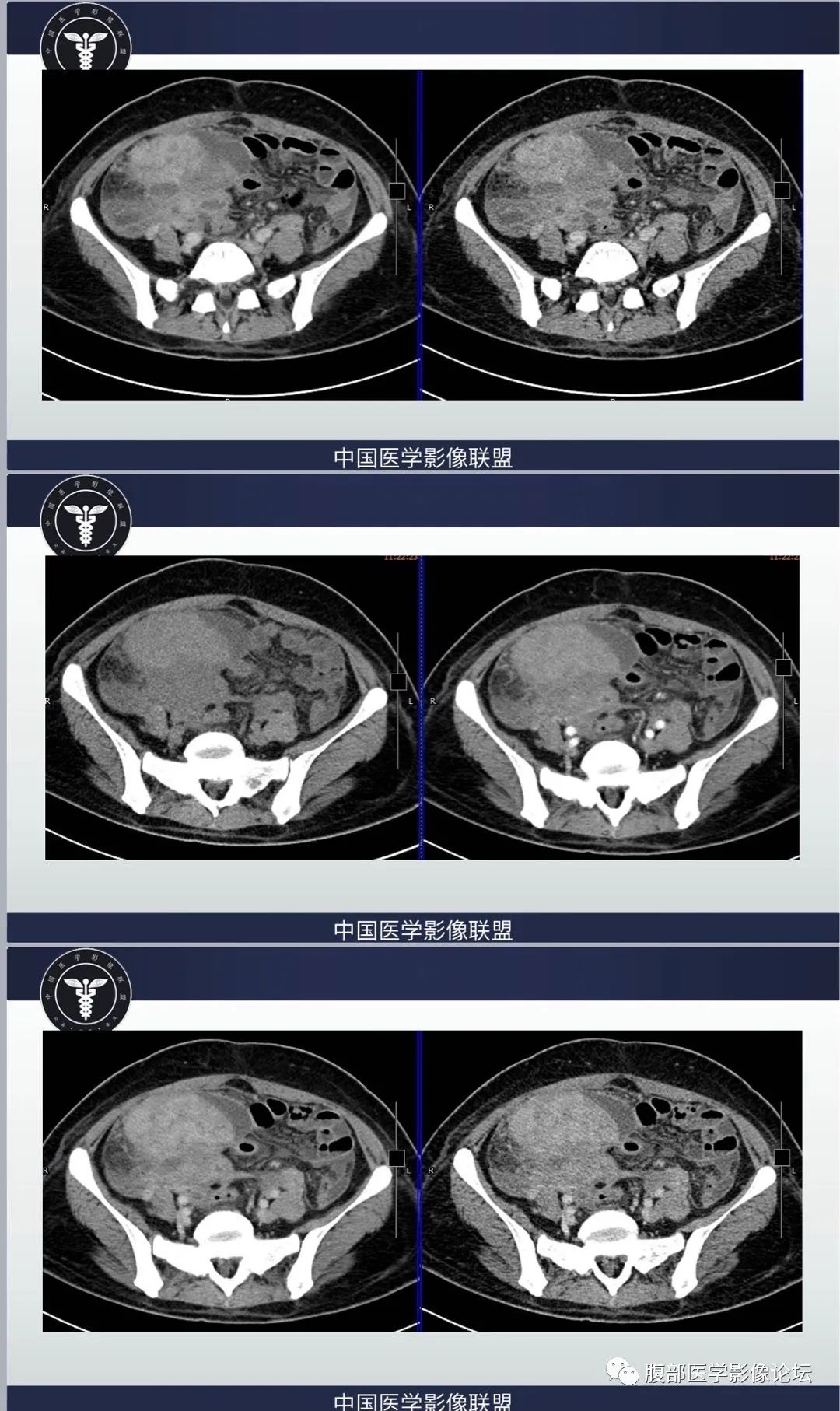 影像PPT - 【病例】肠系膜侵袭性纤维瘤病1例CT-2