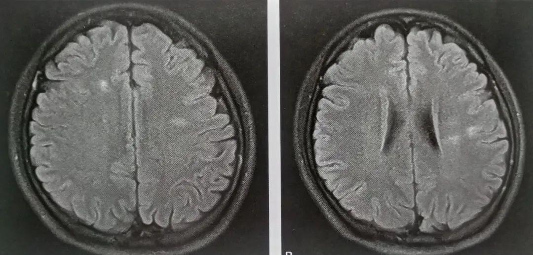 影像PPT - 视神经脊髓炎影像诊断-1 影像PPT - 视神经脊髓炎影像诊断-1