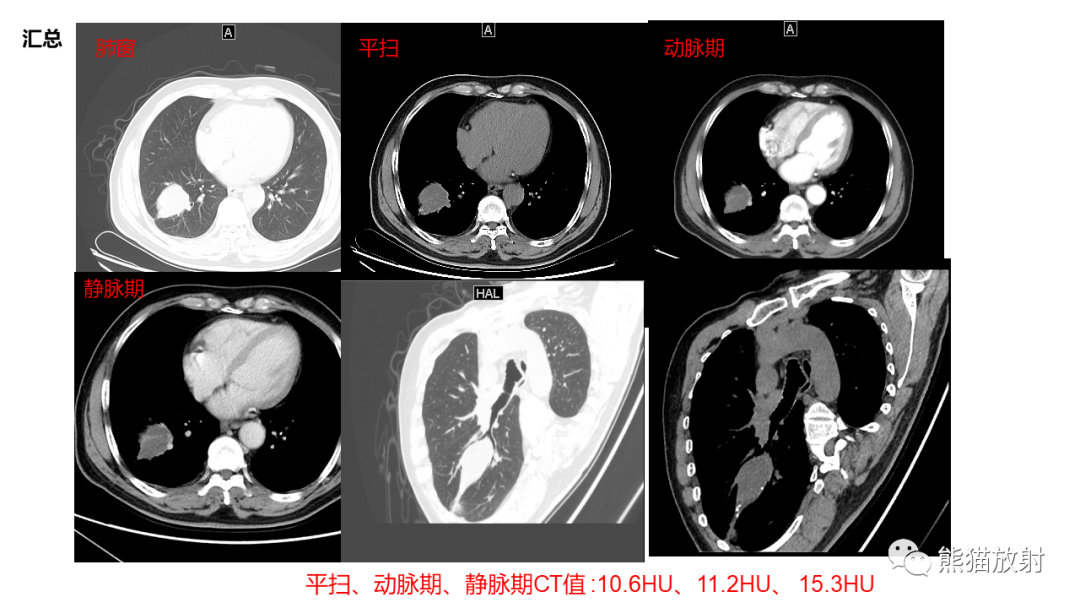 影像PPT - 【病例】肺炎性假瘤 VS 浸润性腺癌-9