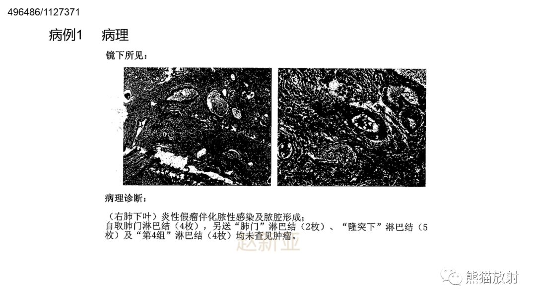 影像PPT - 【病例】肺炎性假瘤 VS 浸润性腺癌-21