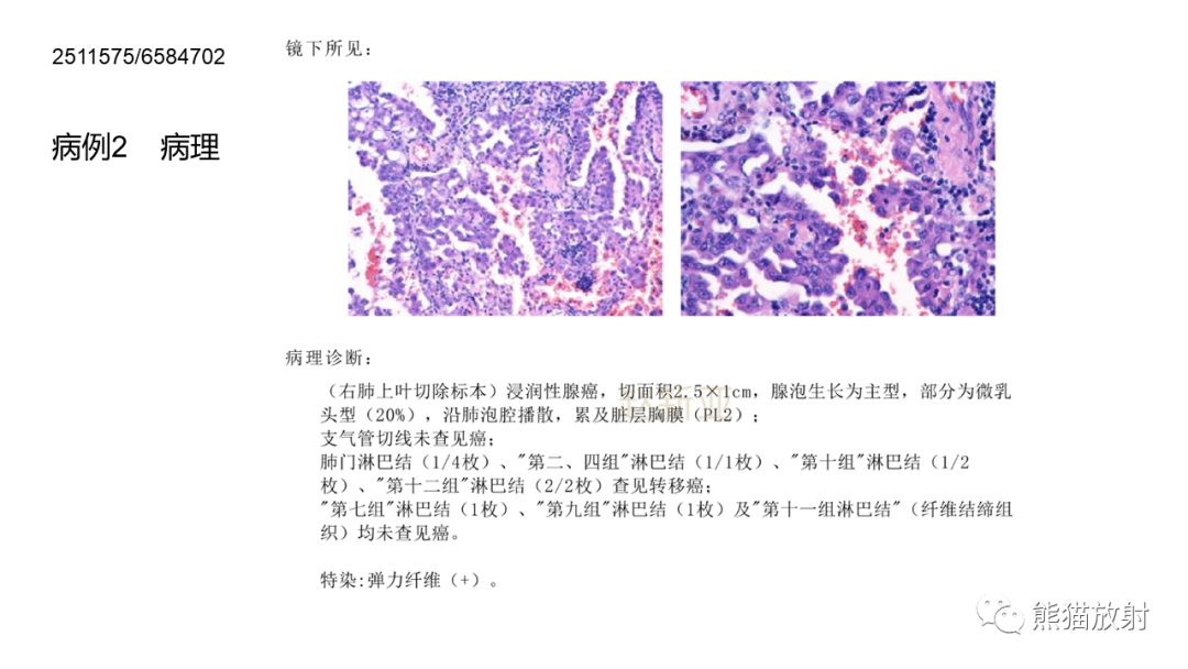 影像PPT - 【病例】肺炎性假瘤 VS 浸润性腺癌-22