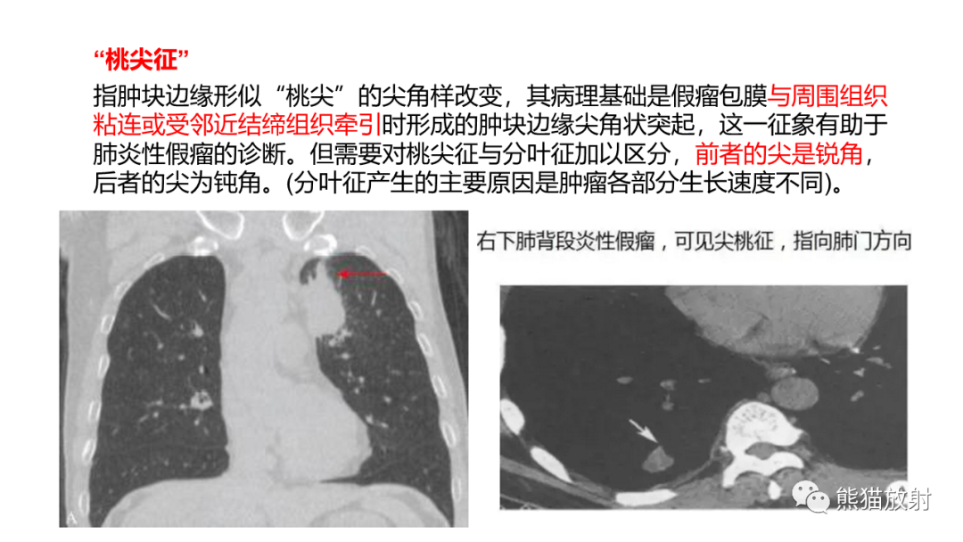 影像PPT - 【病例】肺炎性假瘤 VS 浸润性腺癌-25