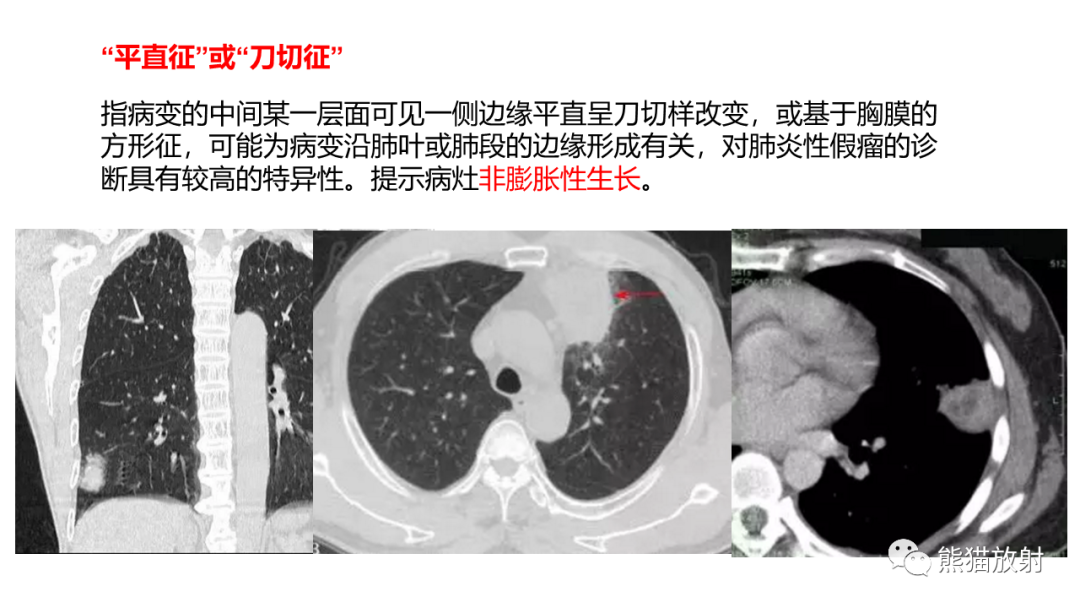 影像PPT - 【病例】肺炎性假瘤 VS 浸润性腺癌-26