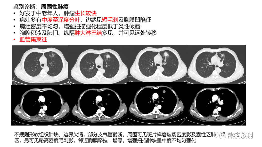 影像PPT - 【病例】肺炎性假瘤 VS 浸润性腺癌-28