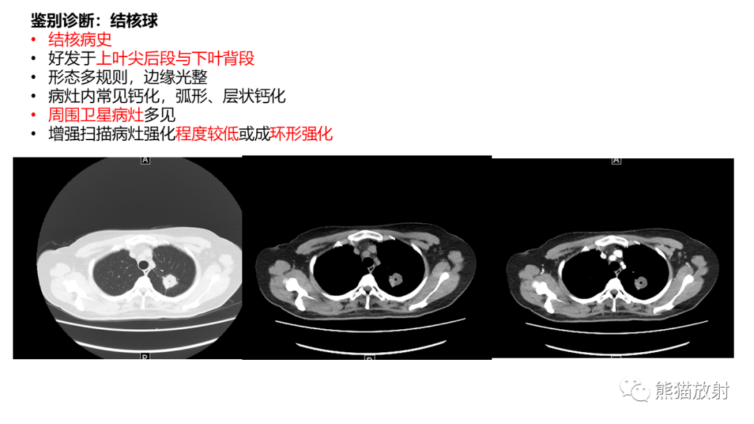 影像PPT - 【病例】肺炎性假瘤 VS 浸润性腺癌-30