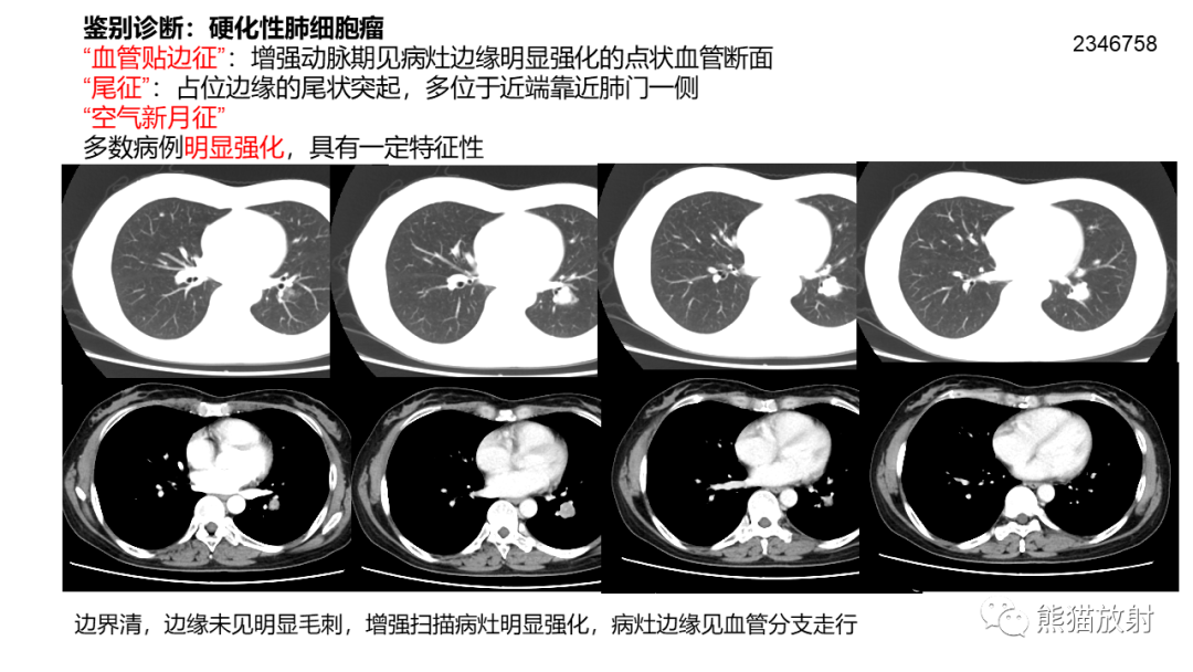 影像PPT - 【病例】肺炎性假瘤 VS 浸润性腺癌-32