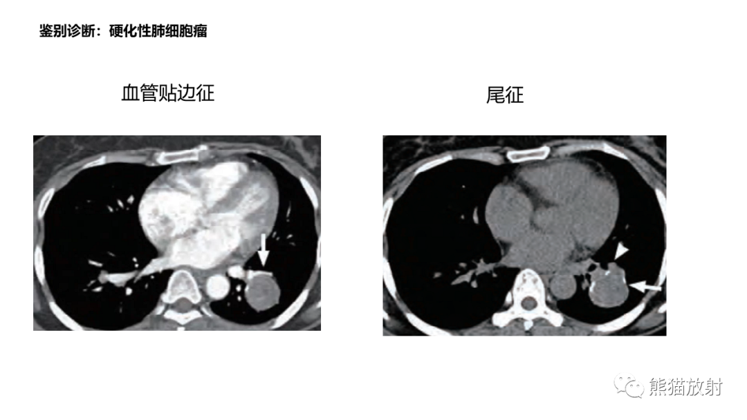 影像PPT - 【病例】肺炎性假瘤 VS 浸润性腺癌-33
