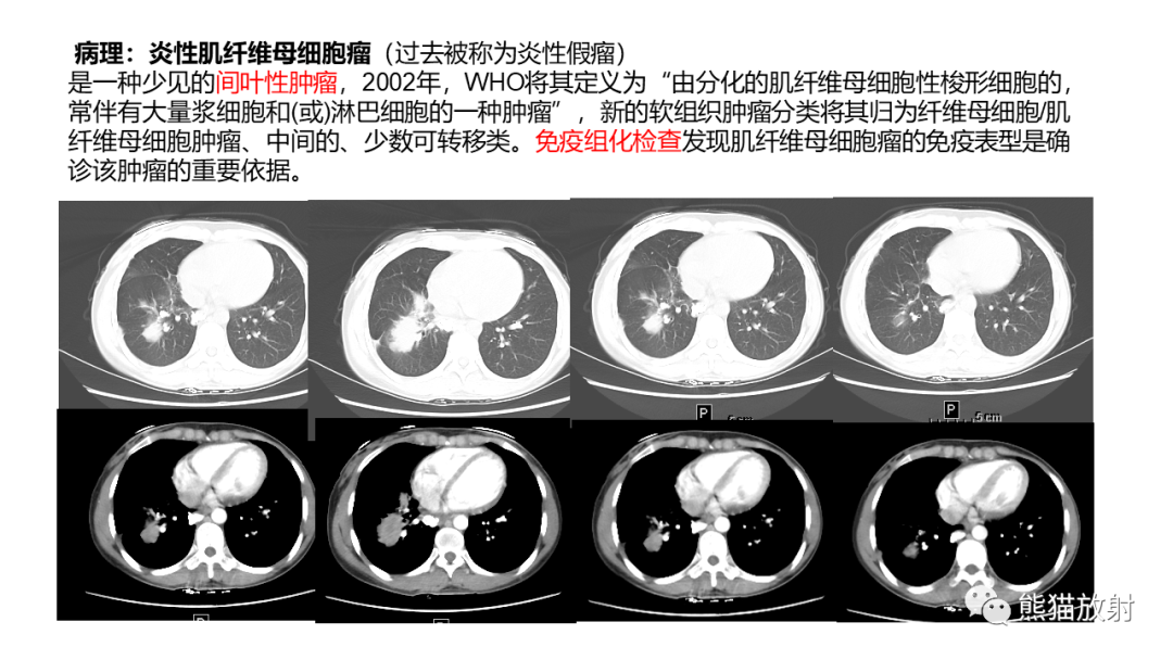 影像PPT - 【病例】肺炎性假瘤 VS 浸润性腺癌-35