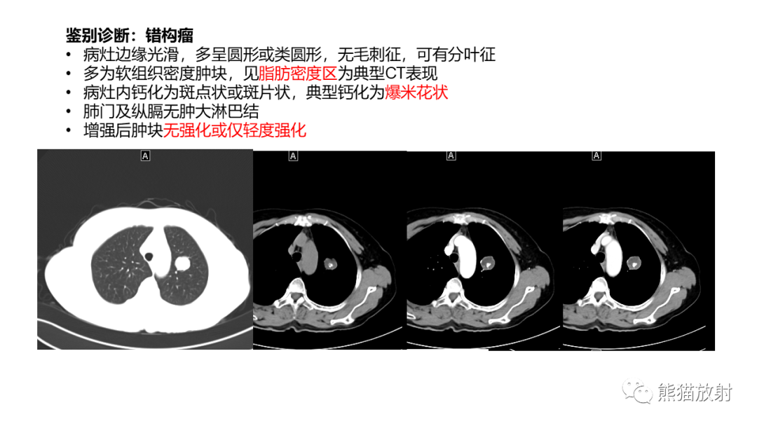 影像PPT - 【病例】肺炎性假瘤 VS 浸润性腺癌-31