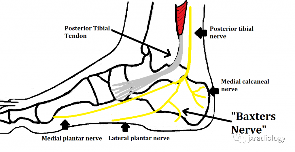 影像PPT - Baxter’s神经卡压 ( Baxter’s Nerve Impingement)-1 影像PPT - Baxter’s神经卡压 ( Baxter’s Nerve Impingement)-1