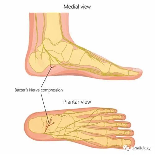 影像PPT - Baxter’s神经卡压 ( Baxter’s Nerve Impingement)-2 影像PPT - Baxter’s神经卡压 ( Baxter’s Nerve Impingement)-2