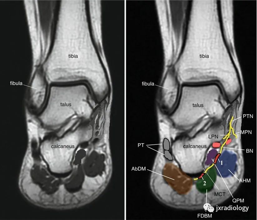 影像PPT - Baxter’s神经卡压 ( Baxter’s Nerve Impingement)-3 影像PPT - Baxter’s神经卡压 ( Baxter’s Nerve Impingement)-3