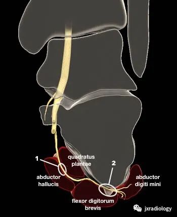 影像PPT - Baxter’s神经卡压 ( Baxter’s Nerve Impingement)-6 影像PPT - Baxter’s神经卡压 ( Baxter’s Nerve Impingement)-6