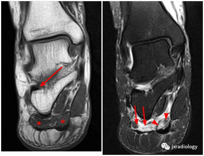 影像PPT - Baxter’s神经卡压 ( Baxter’s Nerve Impingement)-8 影像PPT - Baxter’s神经卡压 ( Baxter’s Nerve Impingement)-8