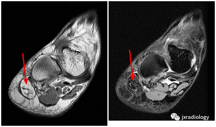影像PPT - Baxter’s神经卡压 ( Baxter’s Nerve Impingement)-9 影像PPT - Baxter’s神经卡压 ( Baxter’s Nerve Impingement)-9