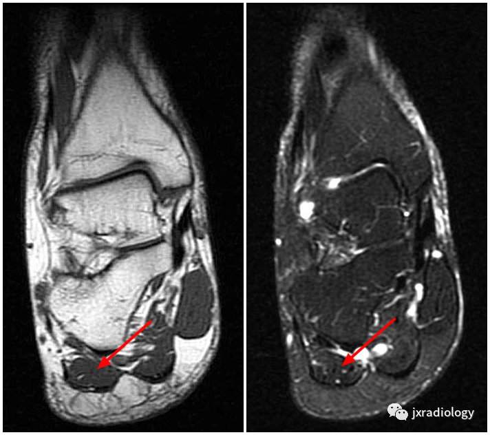 影像PPT - Baxter’s神经卡压 ( Baxter’s Nerve Impingement)-7 影像PPT - Baxter’s神经卡压 ( Baxter’s Nerve Impingement)-7