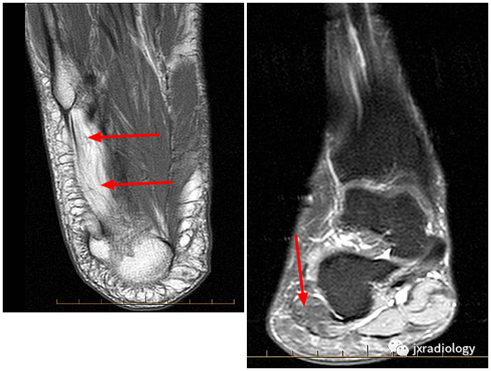 影像PPT - Baxter’s神经卡压 ( Baxter’s Nerve Impingement)-10 影像PPT - Baxter’s神经卡压 ( Baxter’s Nerve Impingement)-10