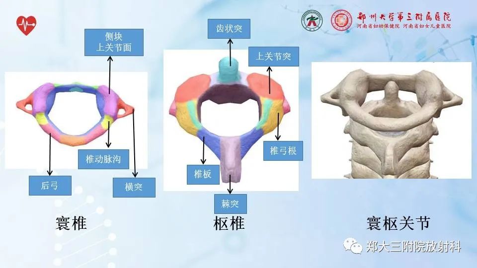 影像PPT - 【PPT】齿状突加冠综合征-5