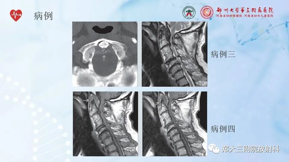 影像PPT - 【PPT】齿状突加冠综合征-11