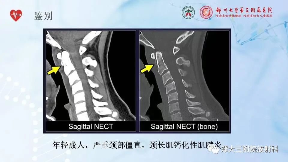 影像PPT - 【PPT】齿状突加冠综合征-12